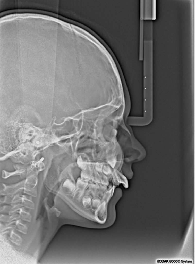Schedelfoto voor de activator-behandeling.