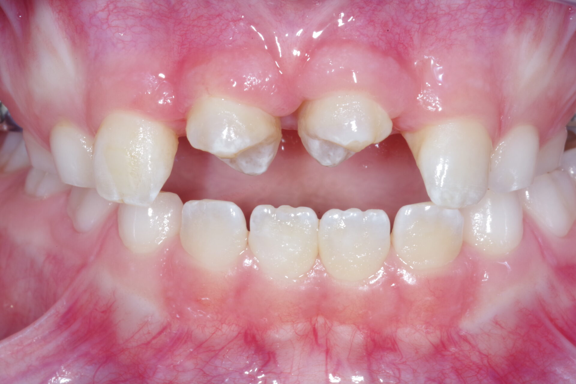 Twee getransplanteerde kiesjes op de plek van de voortanden.