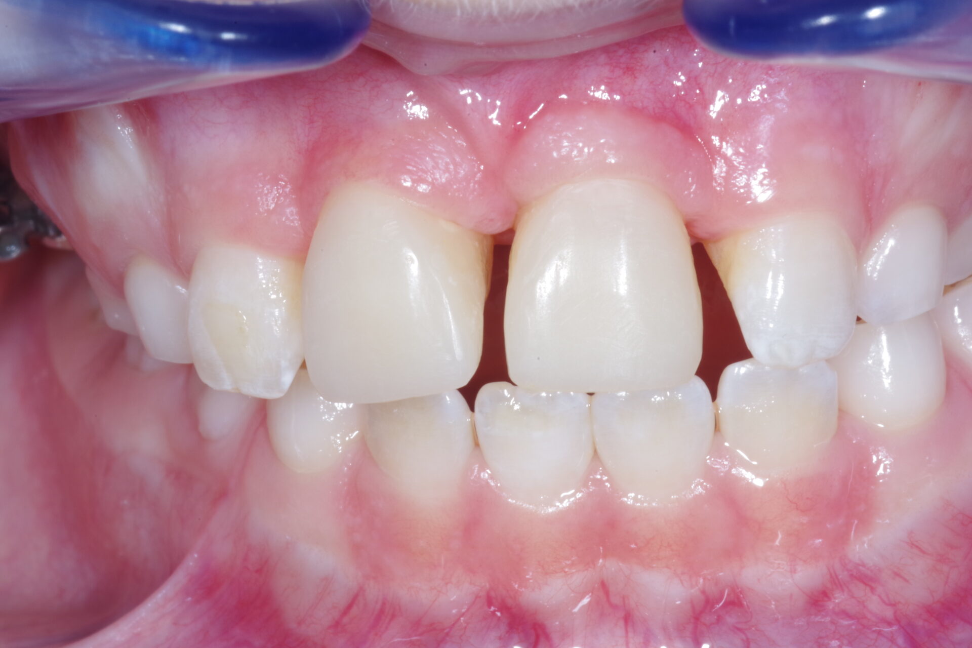 Twee getransplanteerde kiesjes op de plek van de voortanden, opgebouwd.