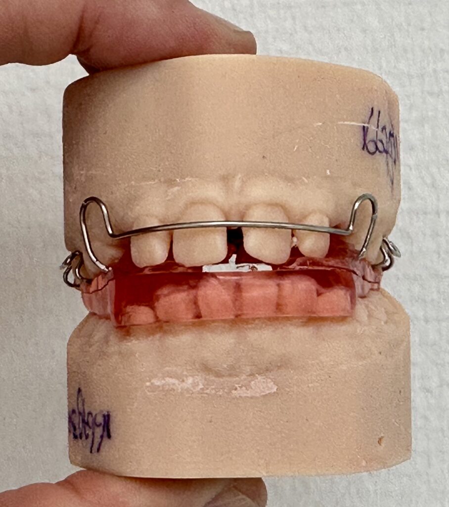 New T-appliance in geprint gebitsmodel
